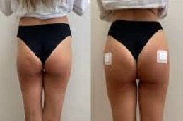 Butt body fillers in Riyadh & Saudi Arabia