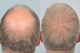 Crown Hair Transplant in Riyadh & Saudi Arabia 