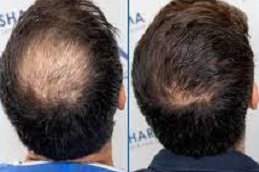 Crown Hair Transplant in Riyadh & Saudi Arabia 