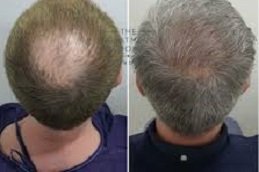 Crown Hair Transplant in Riyadh & Saudi Arabia 