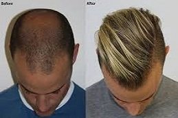 Crown Hair Transplant in Riyadh & Saudi Arabia 