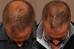 Crown Hair Transplant in Riyadh & Saudi Arabia 