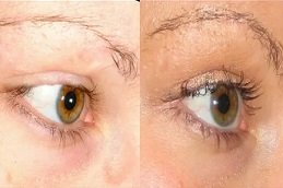 Eyelash hair Transplant in Riyadh & Saudi Arabia