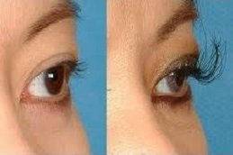 Eyelash hair Transplant in Riyadh & Saudi Arabia