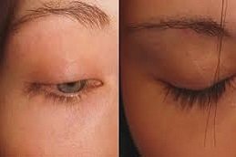 Eyelash hair Transplant in Riyadh & Saudi Arabia