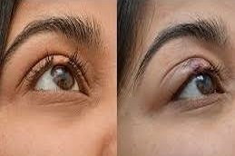 Eyelash hair Transplant in Riyadh & Saudi Arabia