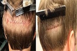 FUT Strip Hair Transplant in Riyadh & Saudi Arabia