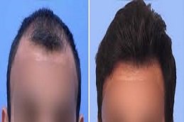 FUT Strip Hair Transplant in Riyadh & Saudi Arabia