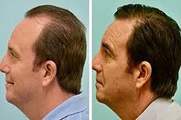 FUT Strip Hair Transplant in Riyadh & Saudi Arabia