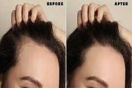 GFC Treatment for Hair in Riyadh & Saudi Arabia