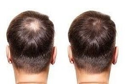 GFC Treatment for Hair in Riyadh & Saudi Arabia