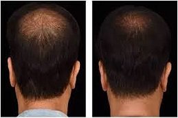 GFC Treatment for Hair in Riyadh & Saudi Arabia