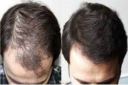 GFC Treatment for Hair in Riyadh & Saudi Arabia