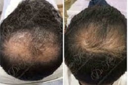 GFC Treatment for Hair in Riyadh & Saudi Arabia