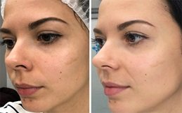 HydraFacial Before and After