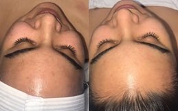 HydraFacial Before and After