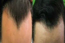 Natural Hairline Treatment in Riyadh & Saudi Arabia