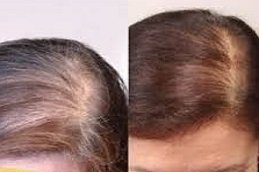 Natural Hairline Treatment in Riyadh & Saudi Arabia