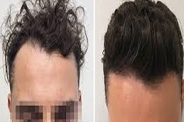 Natural Hairline Treatment in Riyadh & Saudi Arabia