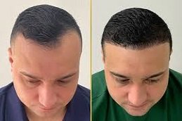 Natural Hairline Treatment in Riyadh & Saudi Arabia