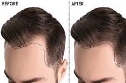 Natural Hairline Treatment in Riyadh & Saudi Arabia