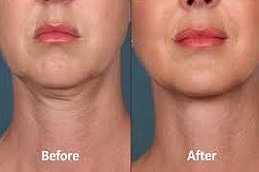 Nefertiti Lift for Jawline in Riyadh & Saudi Arabia