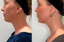 Nefertiti Lift for Jawline in Riyadh & Saudi Arabia