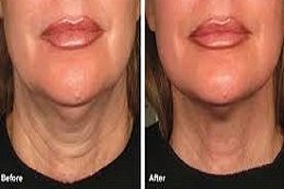 Nefertiti Lift for Jawline in Riyadh & Saudi Arabia