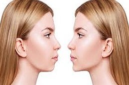 Nefertiti Lift for Jawline in Riyadh & Saudi Arabia