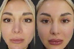 Russian Lip Fillers in Riyadh and Saudi Arabia