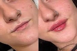 Russian Lip Fillers in Riyadh and Saudi Arabia