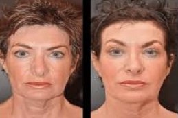 Sculptra fillers in Riyadh & Saudi Arabia 