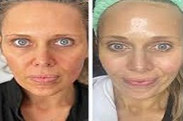 Sculptra fillers in Riyadh & Saudi Arabia 