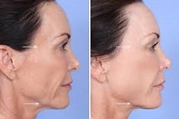 Sculptra fillers in Riyadh & Saudi Arabia 