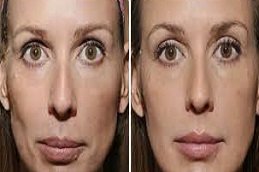 Sculptra fillers in Riyadh & Saudi Arabia 