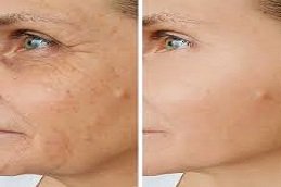 Sculptra fillers in Riyadh & Saudi Arabia 