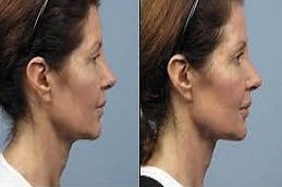 Sculptra fillers in Riyadh & Saudi Arabia 