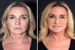 Silhouette Facelift in Riyadh & Saudi Arabia