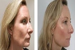 Silhouette Facelift in Riyadh & Saudi Arabia