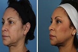 Silhouette Facelift in Riyadh & Saudi Arabia