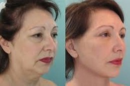 Silhouette Facelift in Riyadh & Saudi Arabia