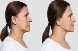 Silhouette Facelift in Riyadh & Saudi Arabia