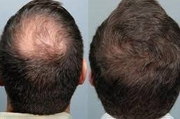 Stem Cell Hair Transplant in Riyadh and Saudi Arabia