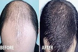 Stem Cell Hair Transplant in Riyadh and Saudi Arabia