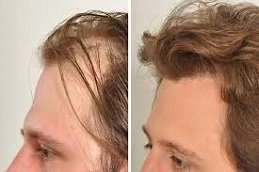 Stem Cell Hair Transplant in Riyadh and Saudi Arabia