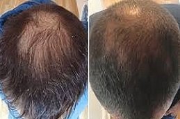 Stem Cell Hair Transplant in Riyadh and Saudi Arabia