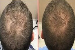 Stem Cell Hair Transplant in Riyadh and Saudi Arabia