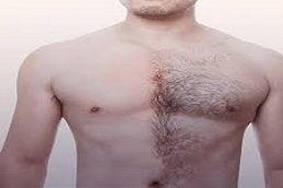 Body Hair Transplant in Riyadh and Saudi Arabia