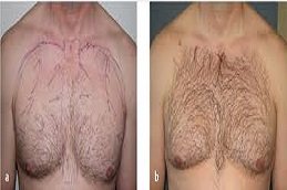 Body Hair Transplant in Riyadh and Saudi Arabia