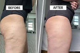 cellulite removal treatment in Riyadh & Saudi Arabia